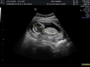 USG Kehamilan di Rumah Sakit Jakarta